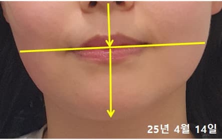 40대 여성 치료 후