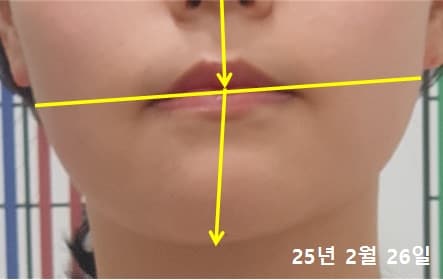40대 여성 치료 전