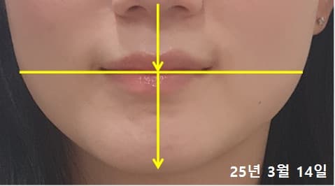 20대 여성 치료 후