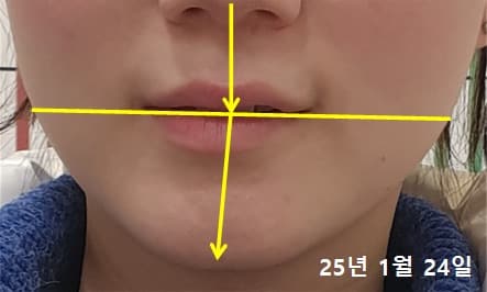 20대 여성 치료 전