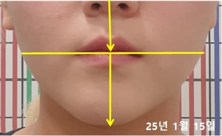 20대 여성 치료 후