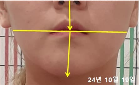20대 여성 치료 전